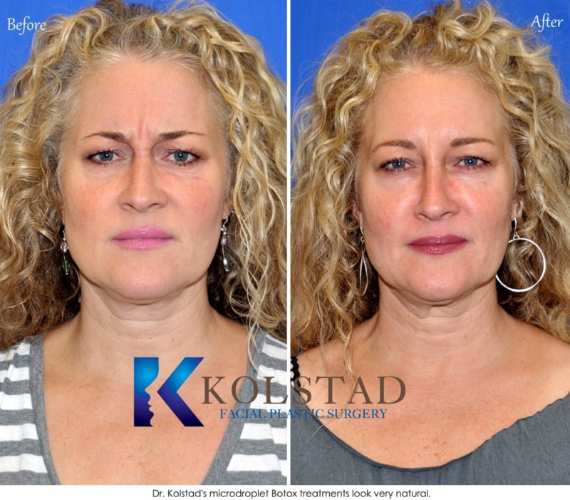 Sd Botox Forehead S Wrinkles Natural Del Mar La Jolla Best Doctor