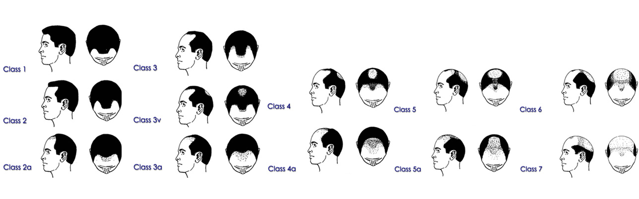 Men's Hair Loss | Kolstad Hair Restoration