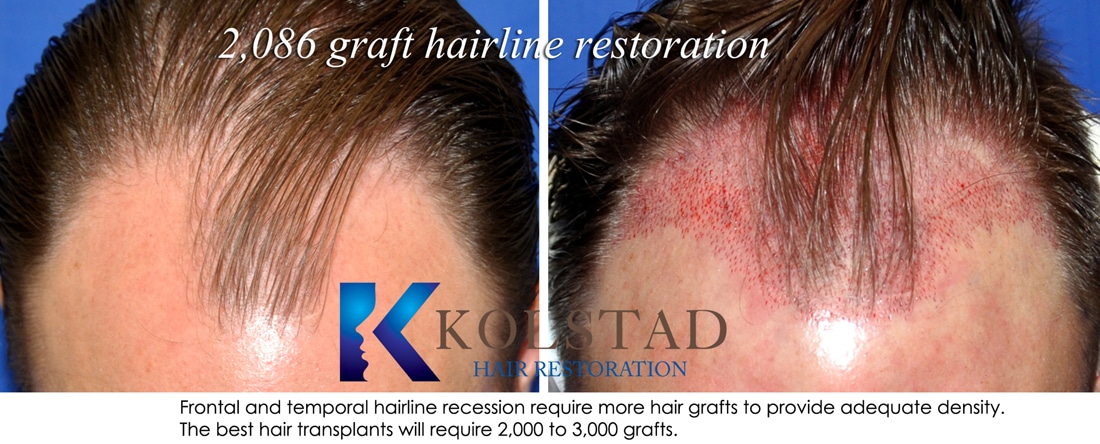 Before & After Gallery | Kolstad Hair Restoration