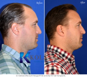 natural hair transplant results