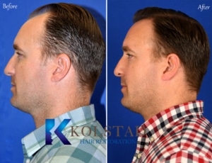 male hair transplant before and after