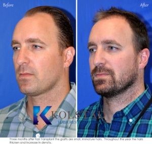 early hair transplant results