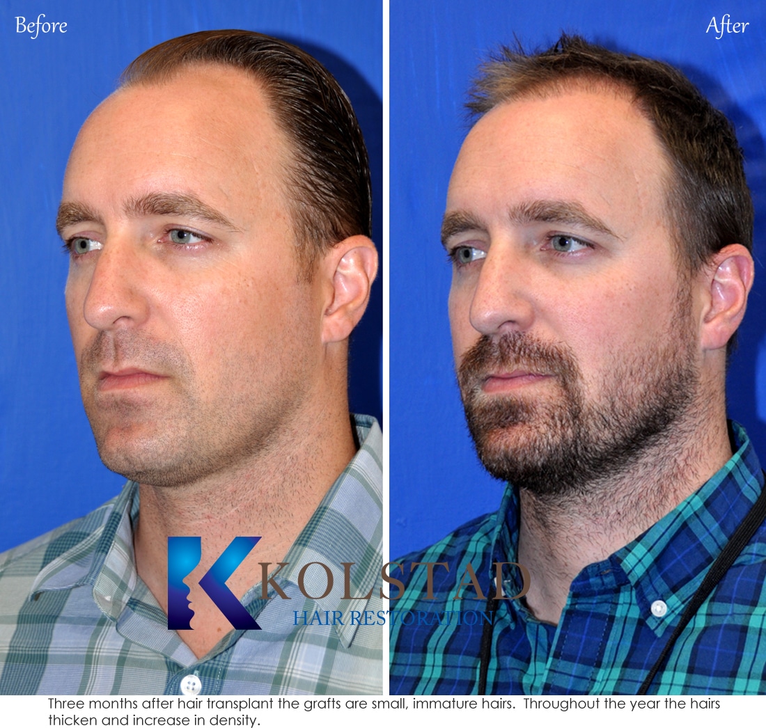 Mens Hair Transplant Cost and Results | Hairline Transplant Before & After  UK
