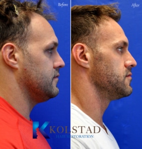 hair transplant for temples