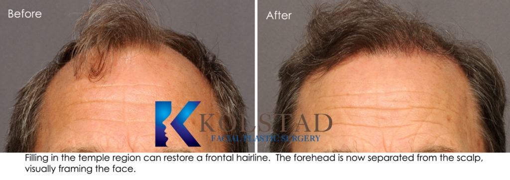 natural hair restoration surgery