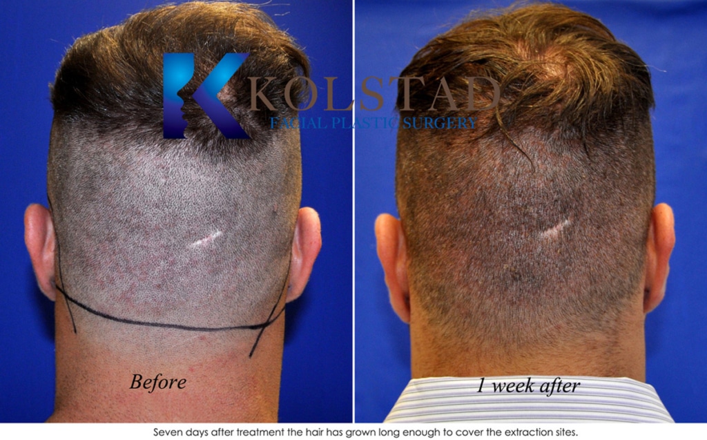 Hair Transplant San Diego Case 15 Kolstad Hair Restoration