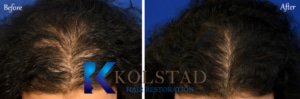 prp hair therapy san diego