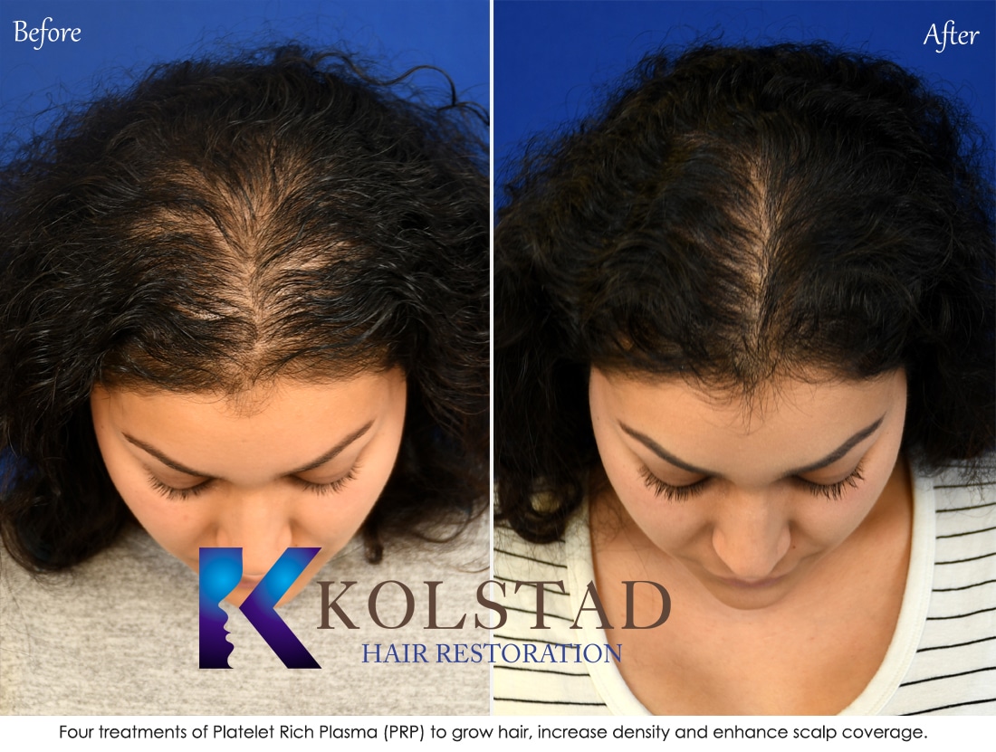 PRP Hair Treatment | Kolstad Hair Restoration