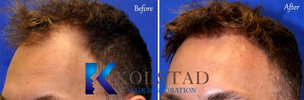 1000 FUE Hair Transplant 4.5 Month Follow Up - Fallon Hair Restoration