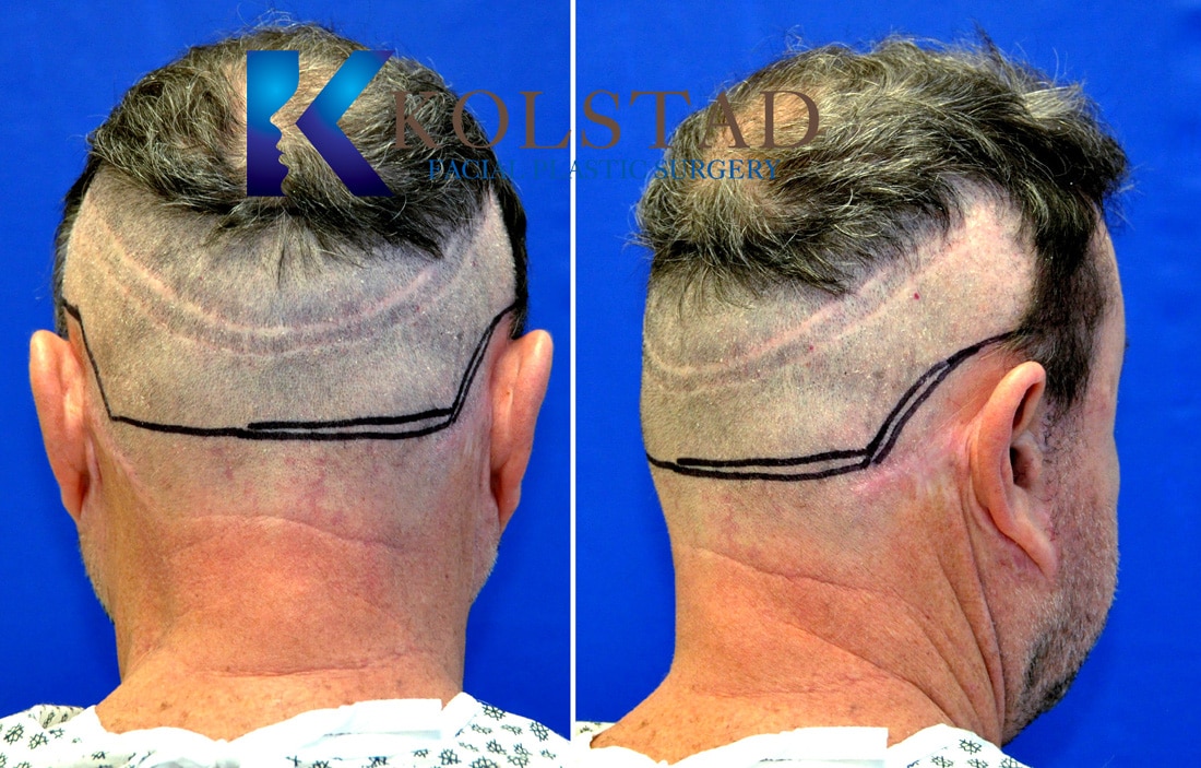 Hair Transplant by Strip Method | Kolstad Hair Restoration