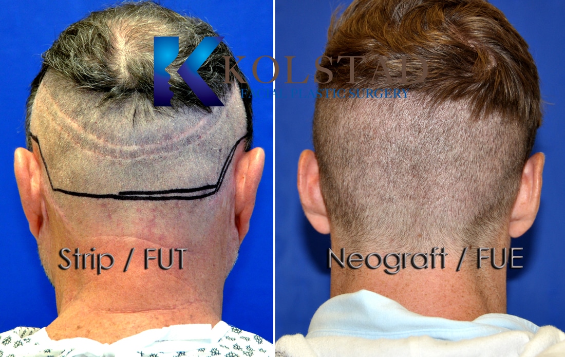 Hair restoration NeoGraft | San Diego CA