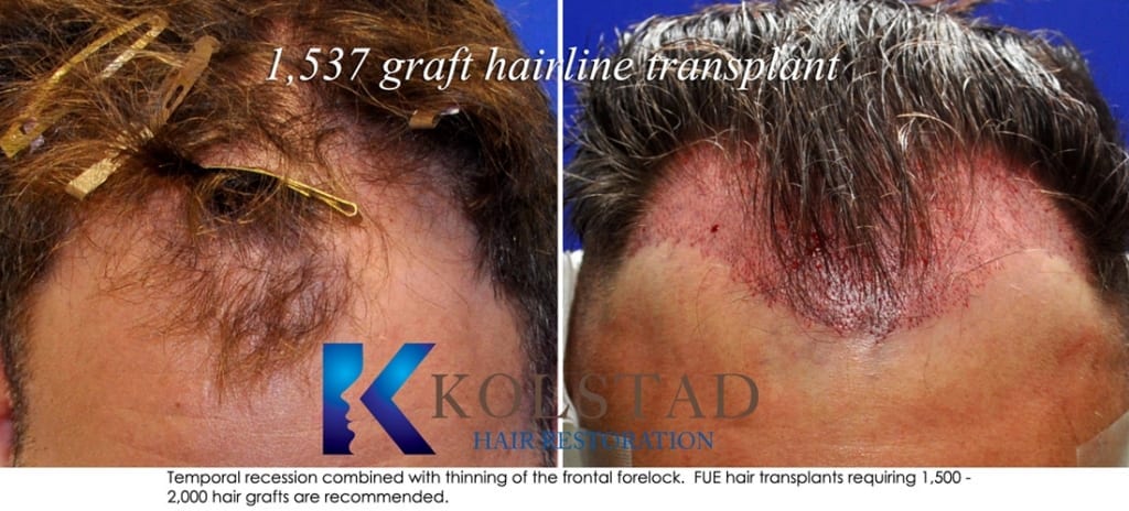 frontal hairline restoration san diego