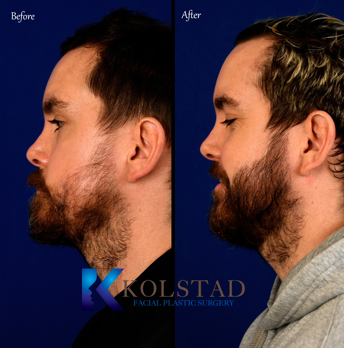 beard transplant san diego case 32 | Kolstad Hair Restoration