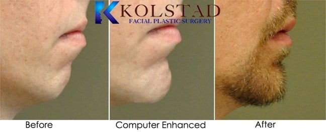 Chin Augmentation Virginia Beach - Chin Implant Norfolk