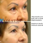 cosmetic eye surgery san diego 106 copy