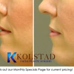 restylane lip augmentation