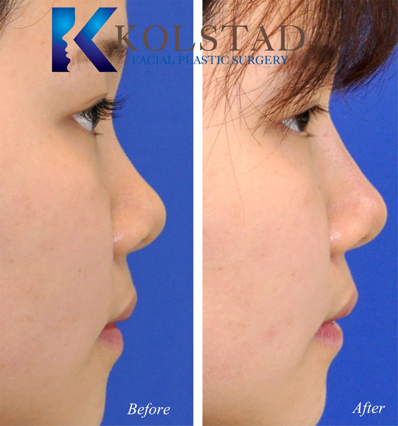 Asian Rhinoplasty San Diego 204