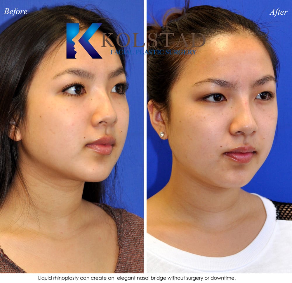 Liquid Asian Rhinoplasty Before After Gallery Dr Kolstad San Diego Facial Plastic Surgeon