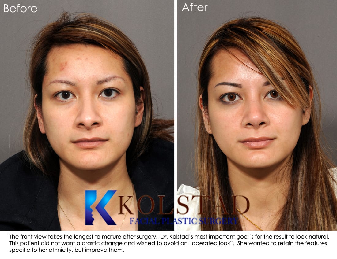 Asian Rhinoplasty Specialist San Diego 4 | Dr. Kolstad - San Diego Facial  Plastic Surgeon