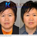 Asian eyelid surgery san diego 1