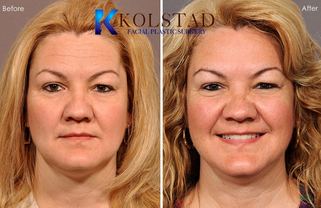 Botox Procedure San Diego Before & After