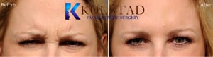 Botox Injections San Diego CA