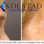 sd botox brow lift