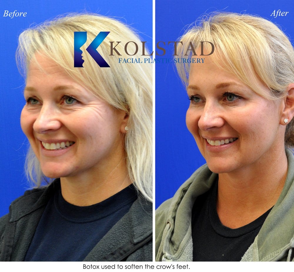 Botox Procedure San Diego Before & After