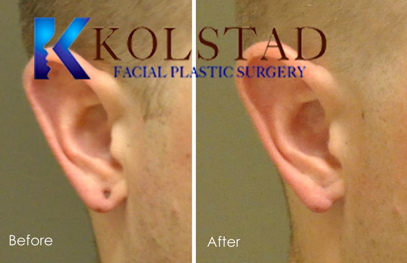 Ear Gauge Repair - Sand Plastic Surgery of Spokane