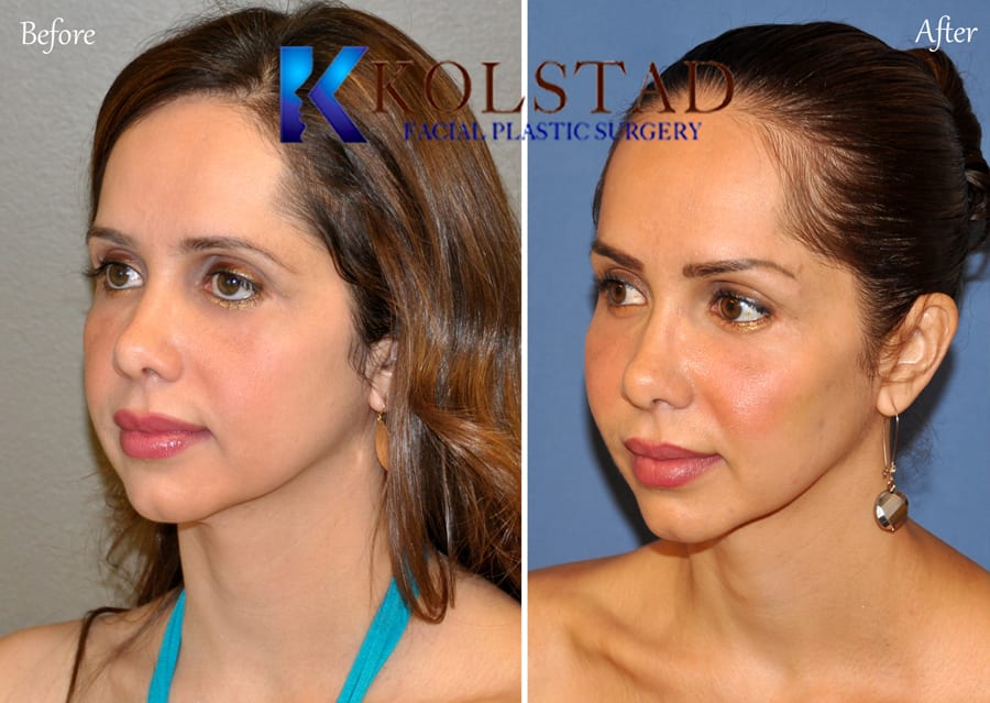 facial Fat Transfer San Diego 