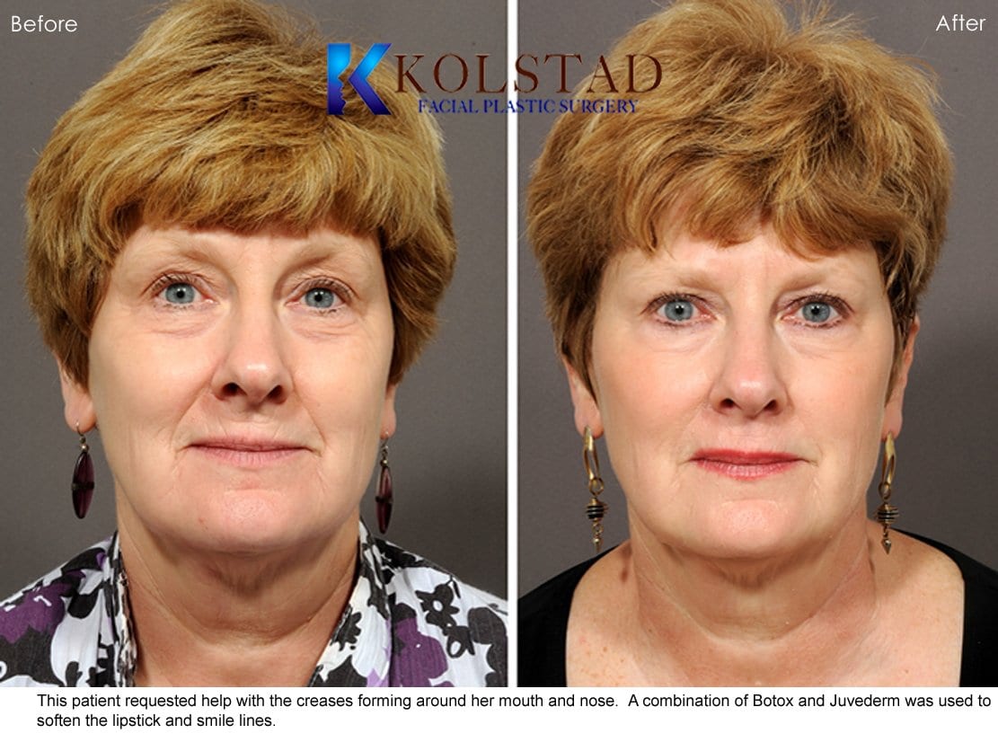 Juvederm San Diego Before & After 