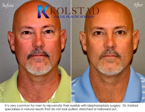 Before and after photos of male blepharoplasty