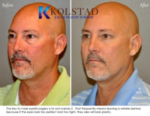 Before and After Male Lower Blepharoplasty
