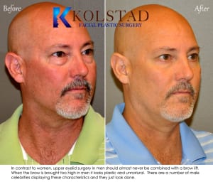 male lower eye lid surgery