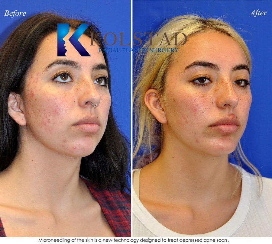 acne scar treatment san diego 17