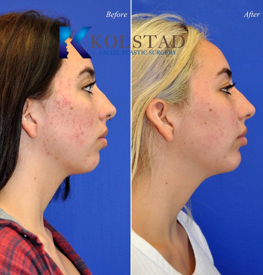 acne scar treatment san diego 18