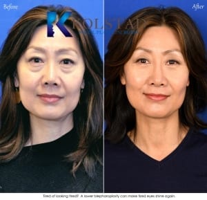 Photos of Asian Women Lower Eyelid Rejuvenation