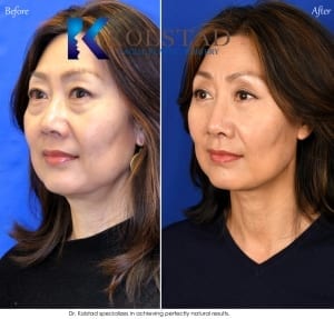 Natural Asian Blepharoplasty results before and after