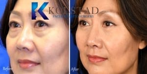 asian nose job san diego