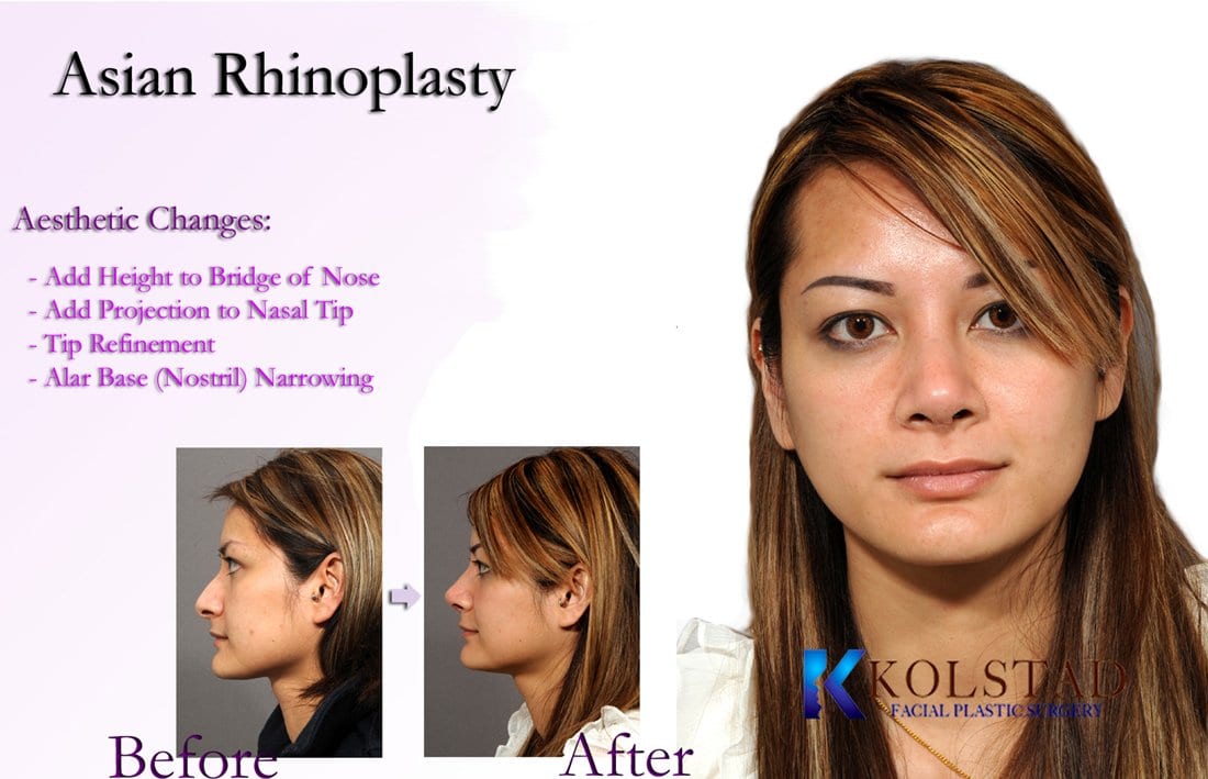 asian rhinoplasty