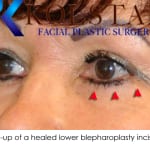 blepharoplasty scar 3