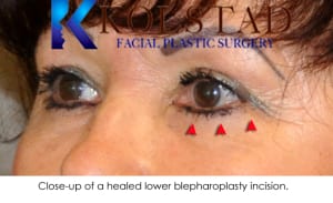 blepharoplasty scar 3