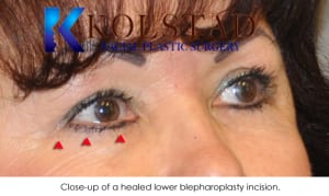 blepharoplasty scar 4