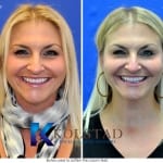 botox before and after near me