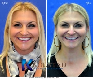 botox before and after near me