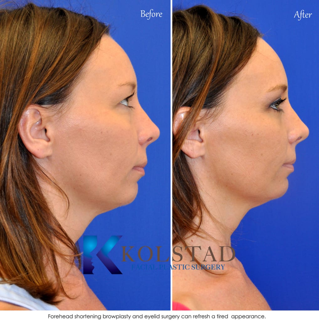 Eyebrow lift case 16 Dr. Kolstad San Diego Facial Plastic Surgeon