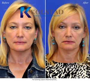 cosmetic eyelid surgery san diego 437 copy