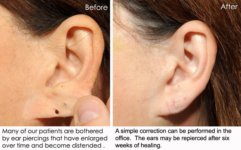 San Diego Earlobe Repair & Mole Removal San Diego Mole