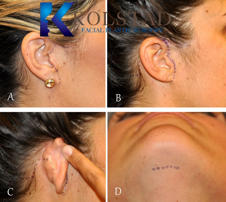 Facelift incisions