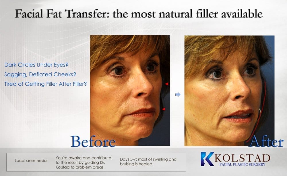 Fat Transfer San Diego  Dr. Kolstad - San Diego Facial Plastic Surgeon